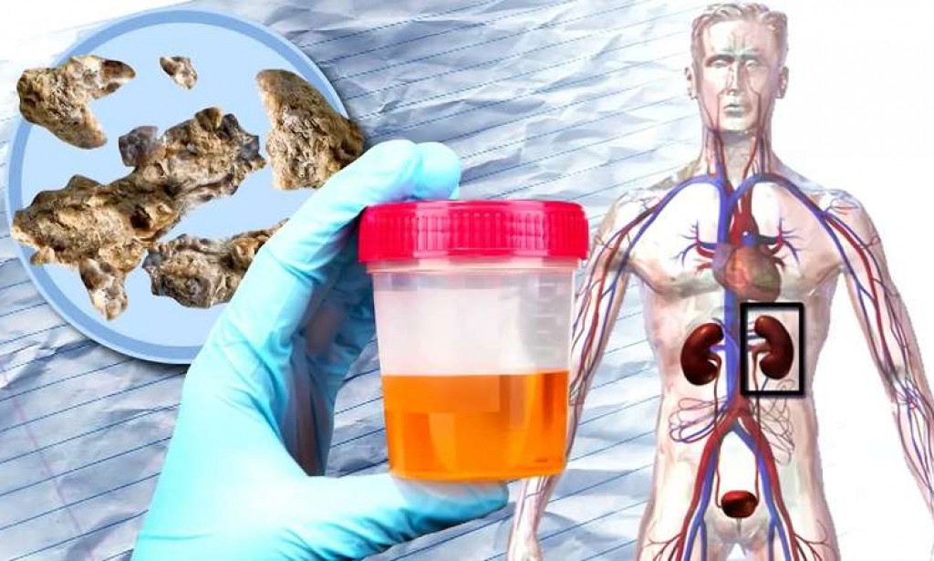 Dietary habits that facilitate Controlling Urinary organ stones