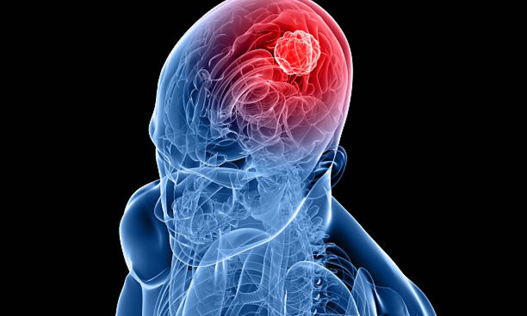 What are brain tumors? Some early signs and symptoms