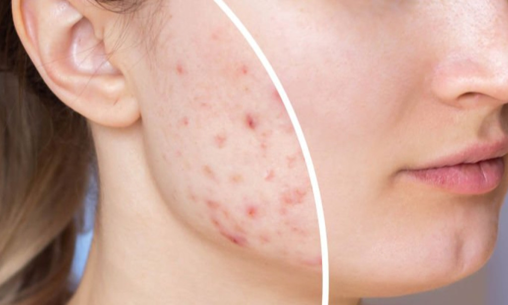 **Figuring out Pimples: Causes, symptoms,Medicines, and Prevention**