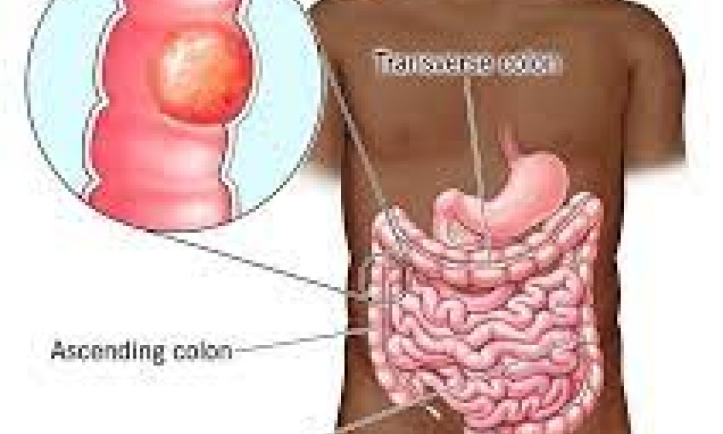 The main reason for the rapid spread of cancer among young people has come to light