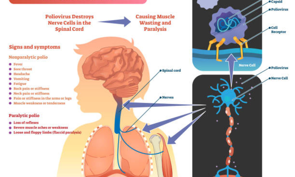 Unbeaten Enemy: The Mysterious Resilience of Poliovirus in Pakistan