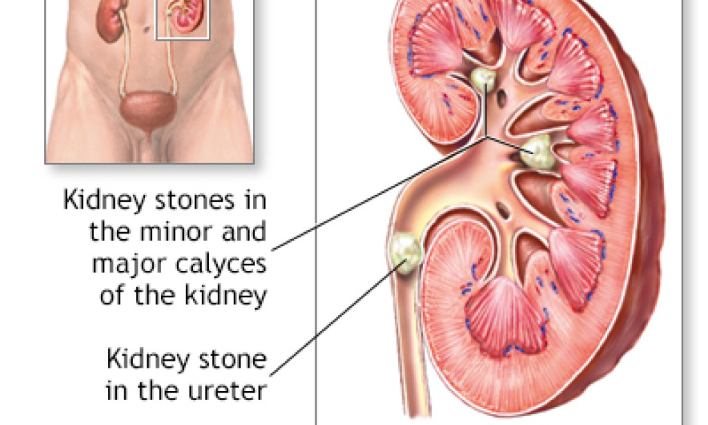 Understanding Kidney Stones: Causes, Incidental effects, and Treatment