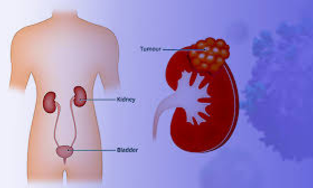 5 Doctors Share Exciting Advances in Kidney Cancer Research  treatments for kidney cancer