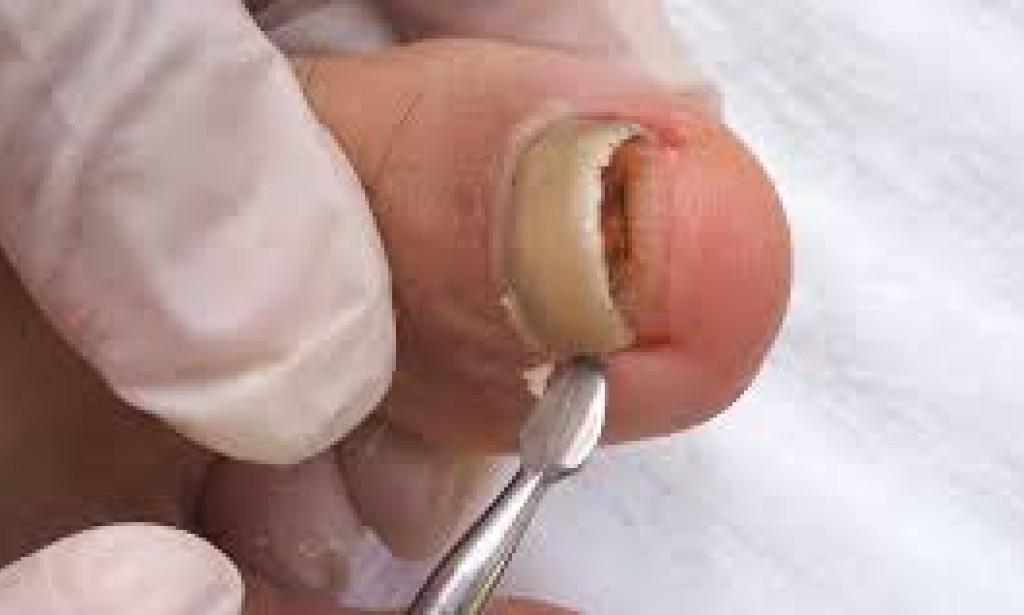 Nail Care Tips for Diabetic Patients: Protect Your Health infections or fungal growth.