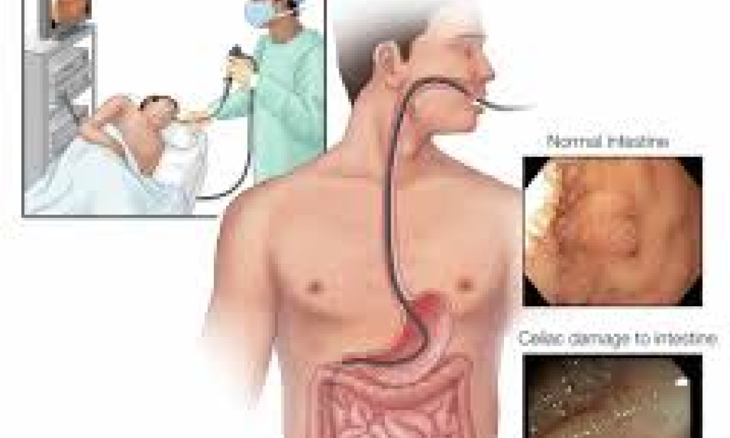 Understanding Celiac Disease: A Complete Guide to Gluten-Free Diet