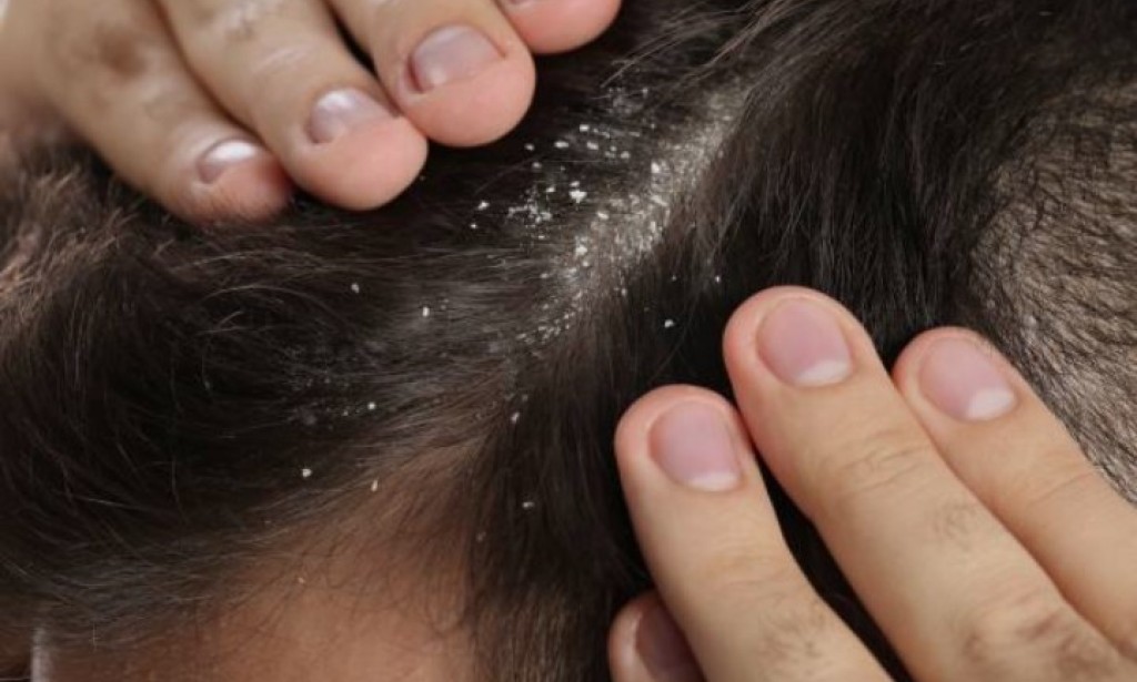 Say Goodbye To Dandruff:Simple Ways To Get AHeakthy Scalp